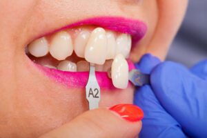 veneers Cottonwood Heights cosmetic dentist near me